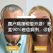 国产病理模型开源！覆盖90%癌症病例，诊